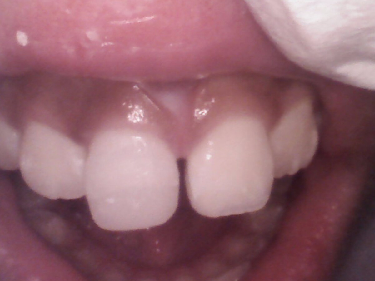 Alignment and gum health result after treatment at Gumdent