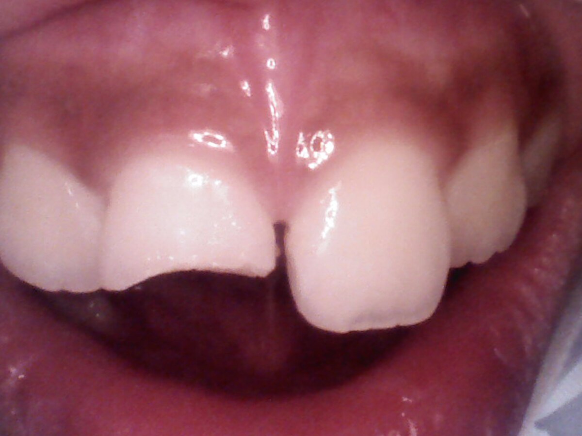 Alignment and gum health before treatment at Gumdent