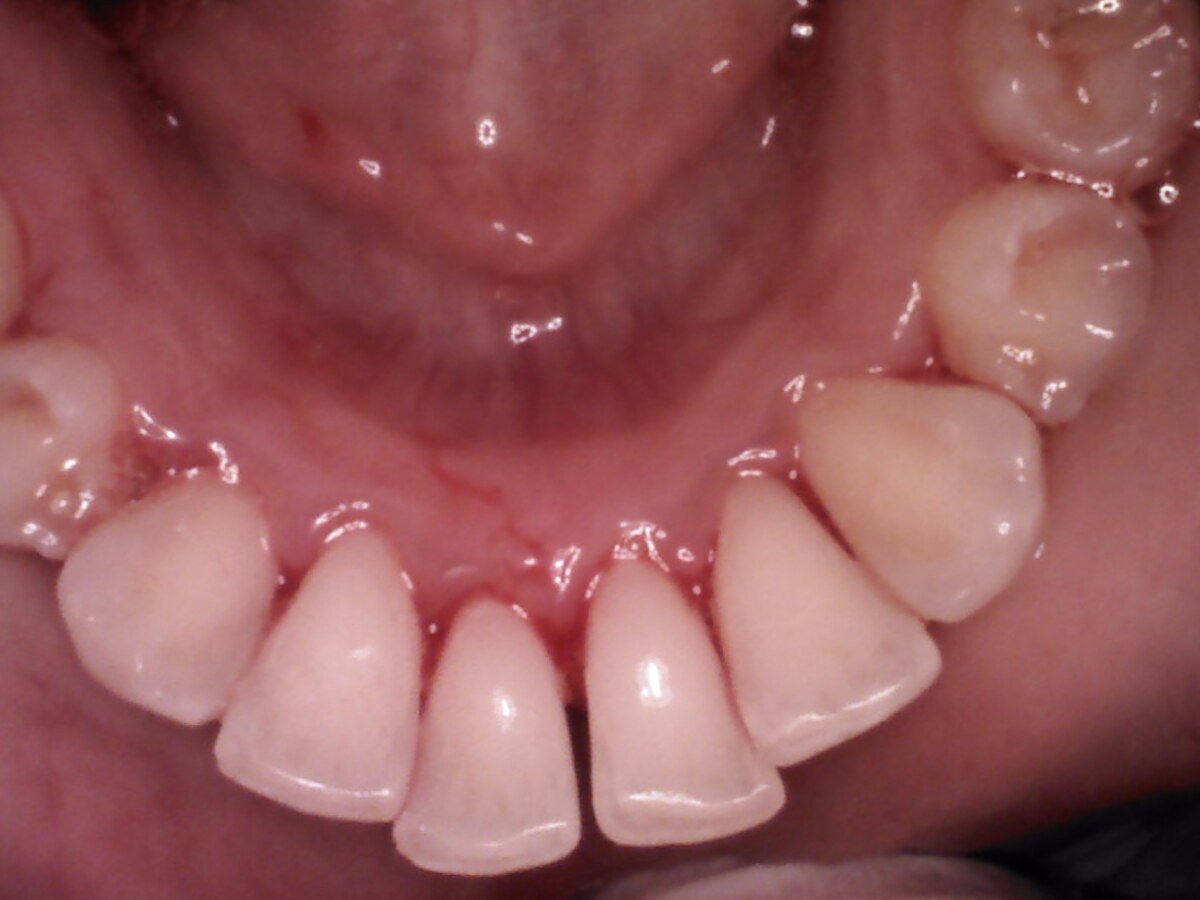 Restorative treatment result after treatment at Gumdent