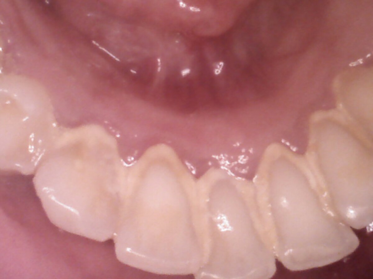 Restorative treatment before treatment at Gumdent