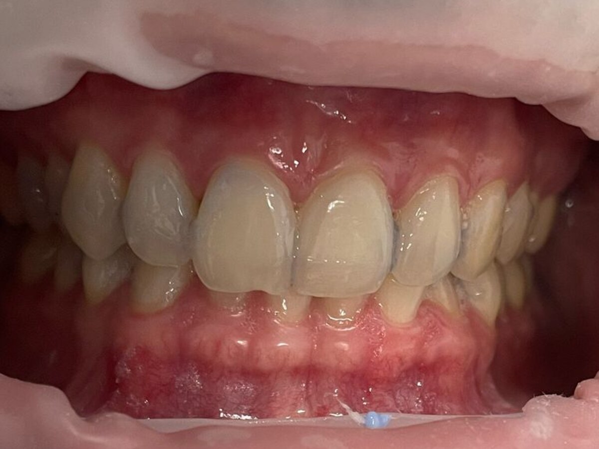 Professional teeth whitening result after treatment at Gumdent