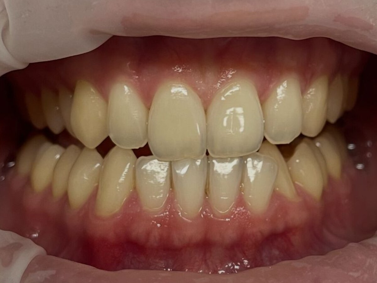 Professional teeth whitening before treatment at Gumdent